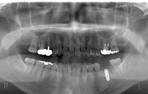 After image