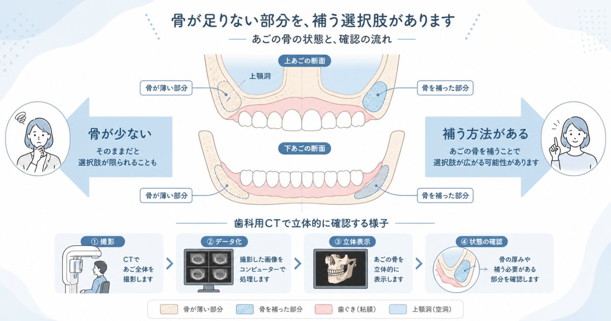 断られた経験がある方へ|あごの骨が少なくてもインプラントは可能?