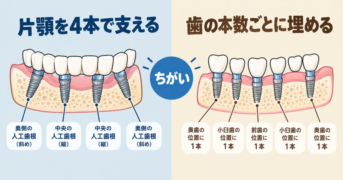 オールオン4と個別埋入は埋入本数の仕組みが根本的に異なる