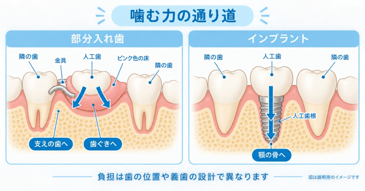 奥歯を失った方へ｜部分入れ歯とインプラントの噛む力・歯への負担