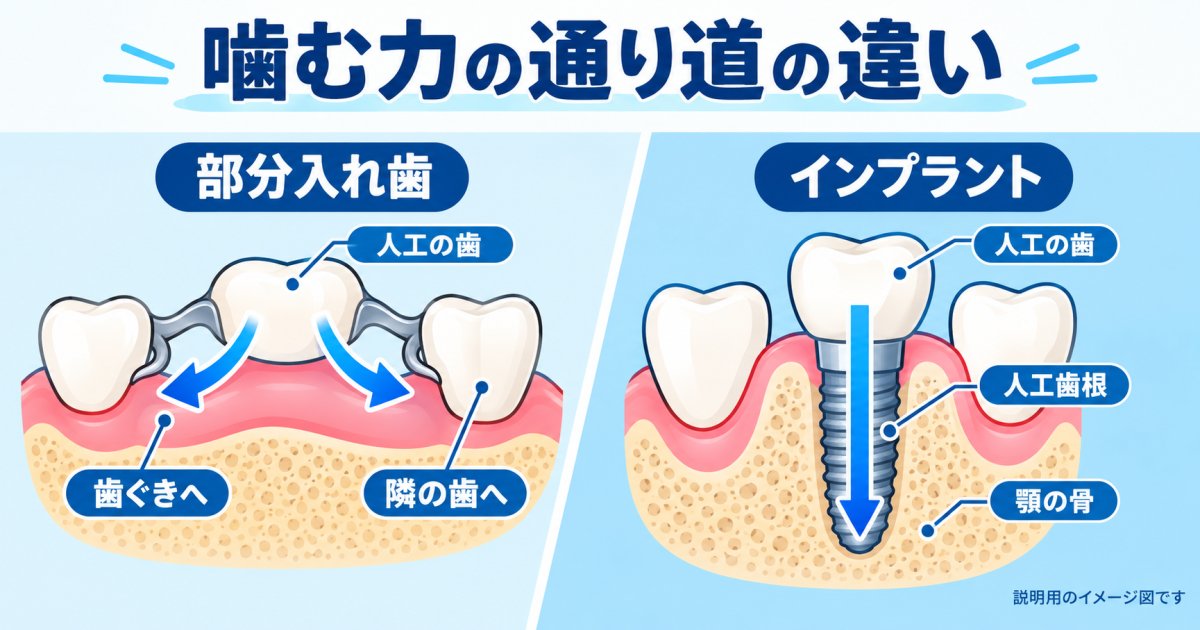 部分入れ歯とインプラントでは、噛む力の伝わり方が違う