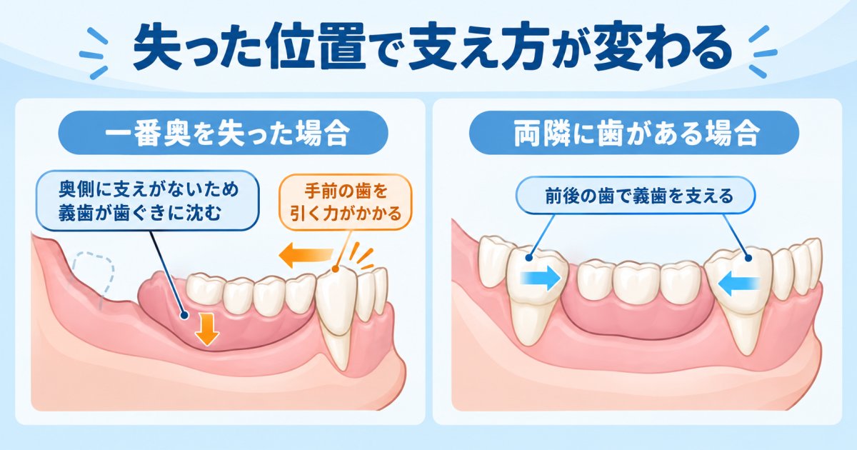 残っている歯への負担は、失った奥歯の位置と支え方で変わる