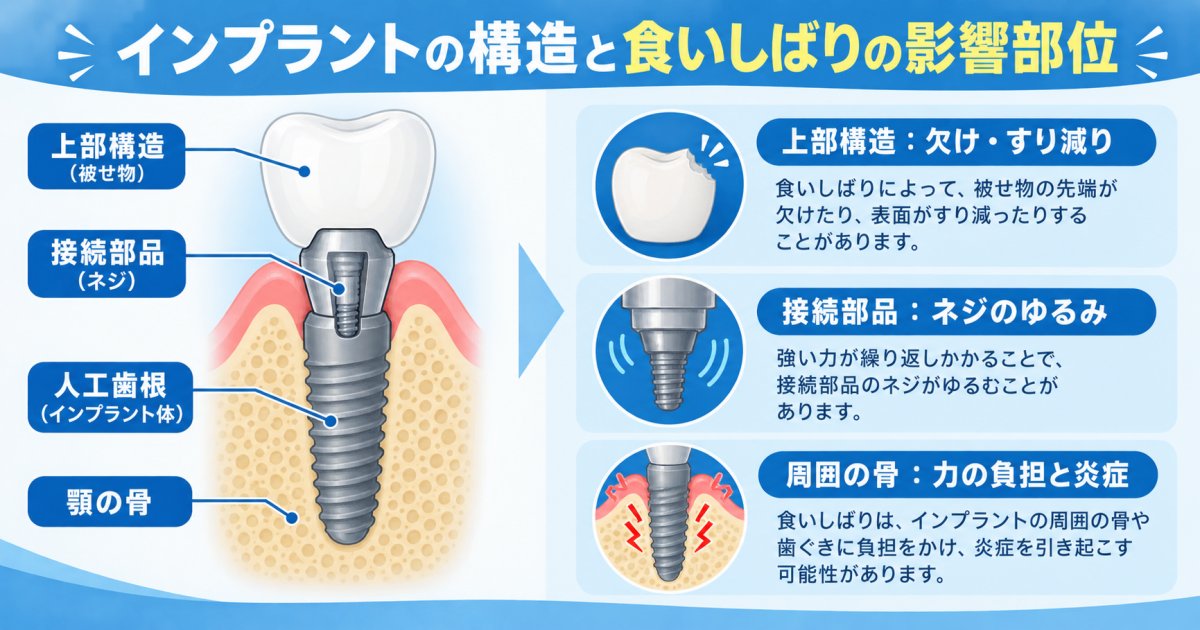 食いしばりが人工歯根へ与える影響を部位別に整理する