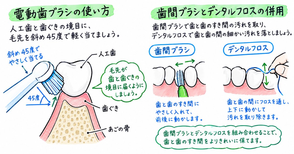 インプラント周りの歯ぐきを守る電動歯ブラシの当て方と使い分け