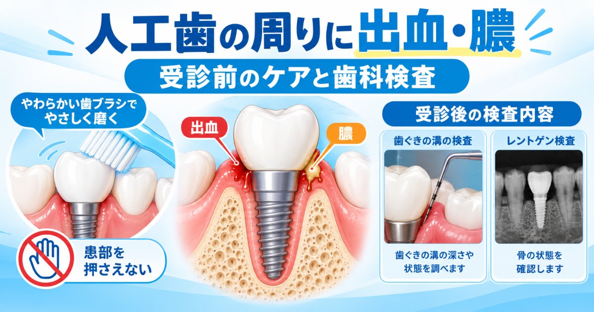 人工歯の周りから出血や膿が見られたら、受診前に控えたい行為と歯科での検査