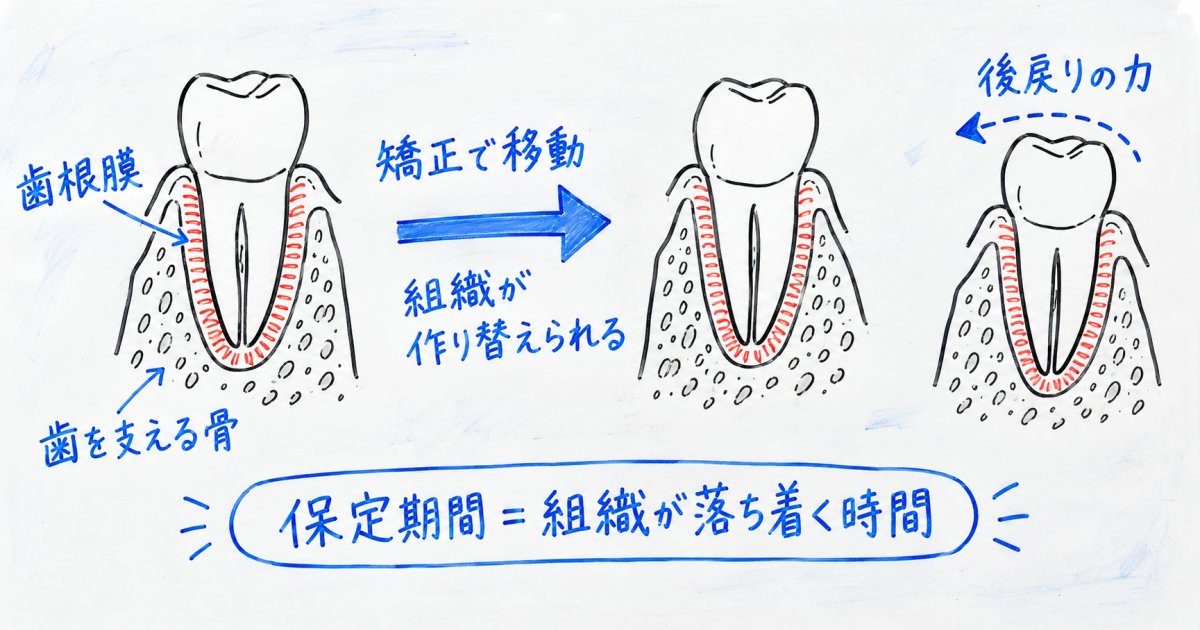 矯正後の後戻りはなぜ起こる？歯が動きやすい保定期間の真実とよくある誤解