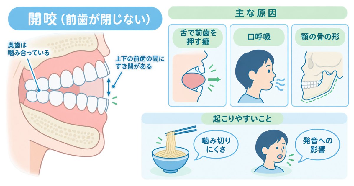 前歯が閉じないのは開咬？食事と発音から考える