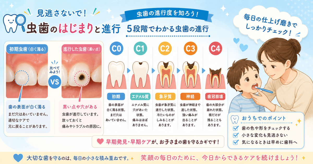 【自宅でセルフチェック】子どもの初期虫歯を見分けるポイントと進行度別の治療