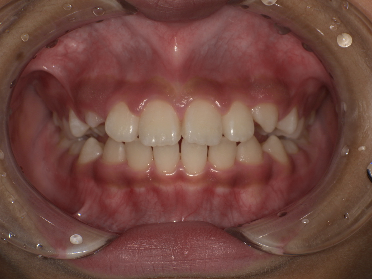 After image
