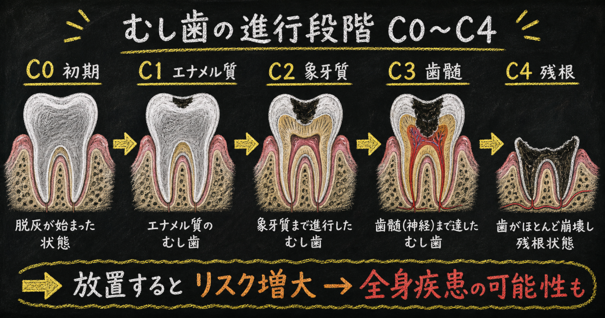むし歯の痛みがある日突然消える理由と「放置の罠」のメカニズム
