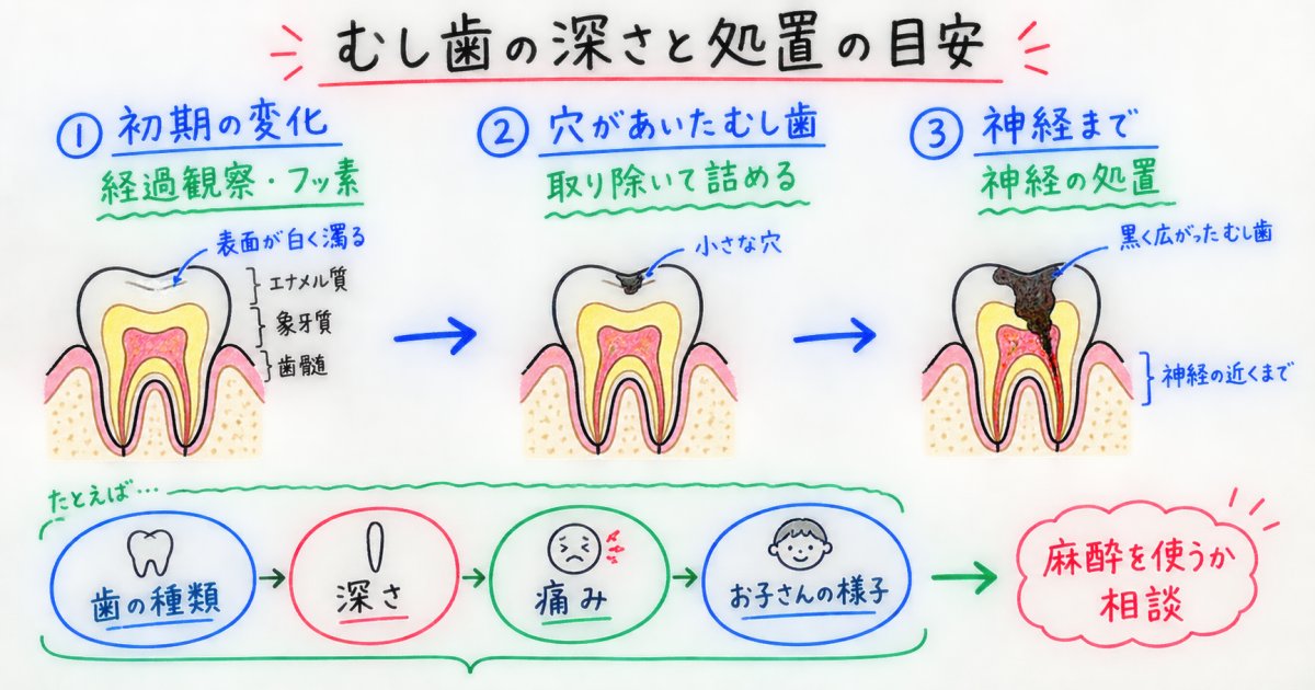子どものむし歯は削る?麻酔を使う?初診で確かめること